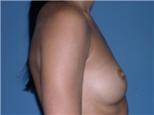 Breast Augmentation Before Photo by Jeffrey Scott, MD; Sarasota, FL - Case 34762