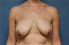 Breast Lift Before Photo by Jeffrey Scott, MD; Sarasota, FL - Case 34765