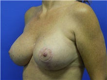 Breast Lift After Photo by Jeffrey Scott, MD; Sarasota, FL - Case 34795