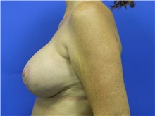 Breast Lift After Photo by Jeffrey Scott, MD; Sarasota, FL - Case 34795