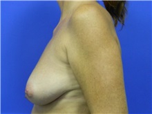 Breast Lift Before Photo by Jeffrey Scott, MD; Sarasota, FL - Case 34795