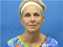 Facelift After Photo by Jeffrey Scott, MD; Sarasota, FL - Case 34797