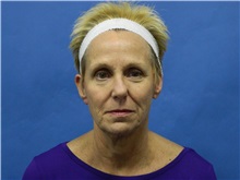 Facelift Before Photo by Jeffrey Scott, MD; Sarasota, FL - Case 34797