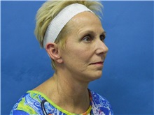 Facelift After Photo by Jeffrey Scott, MD; Sarasota, FL - Case 34797