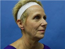 Facelift Before Photo by Jeffrey Scott, MD; Sarasota, FL - Case 34797