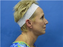 Facelift After Photo by Jeffrey Scott, MD; Sarasota, FL - Case 34797