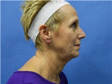 Facelift Before Photo by Jeffrey Scott, MD; Sarasota, FL - Case 34797