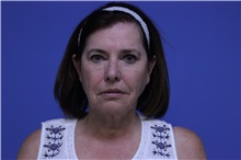 Facelift Before Photo by Jeffrey Scott, MD; Sarasota, FL - Case 34800