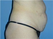 Tummy Tuck Before Photo by Jeffrey Scott, MD; Sarasota, FL - Case 34801