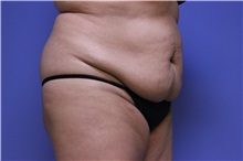 Tummy Tuck Before Photo by Jeffrey Scott, MD; Sarasota, FL - Case 34802