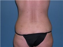 Liposuction After Photo by Jeffrey Scott, MD; Sarasota, FL - Case 34840