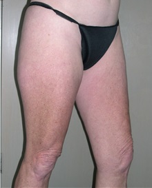 Liposuction Before Photo by Jeffrey Scott, MD; Sarasota, FL - Case 34842