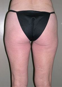 Liposuction Before Photo by Jeffrey Scott, MD; Sarasota, FL - Case 34842