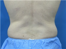 Liposuction Before Photo by Jeffrey Scott, MD; Sarasota, FL - Case 35035