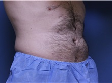 Liposuction After Photo by Jeffrey Scott, MD; Sarasota, FL - Case 35035