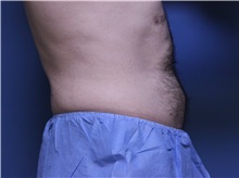 Liposuction After Photo by Jeffrey Scott, MD; Sarasota, FL - Case 35035