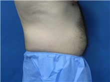 Liposuction Before Photo by Jeffrey Scott, MD; Sarasota, FL - Case 35035