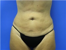 Liposuction After Photo by Jeffrey Scott, MD; Sarasota, FL - Case 35036
