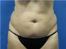 Liposuction Before Photo by Jeffrey Scott, MD; Sarasota, FL - Case 35036