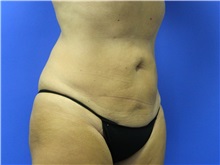 Liposuction After Photo by Jeffrey Scott, MD; Sarasota, FL - Case 35036