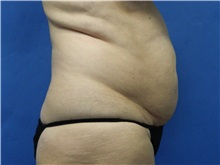 Liposuction Before Photo by Jeffrey Scott, MD; Sarasota, FL - Case 35036