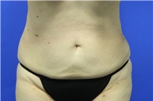 Liposuction After Photo by Jeffrey Scott, MD; Sarasota, FL - Case 35091