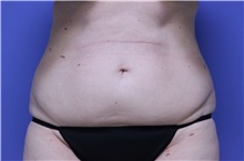 Liposuction Before Photo by Jeffrey Scott, MD; Sarasota, FL - Case 35091