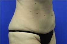 Liposuction After Photo by Jeffrey Scott, MD; Sarasota, FL - Case 35091