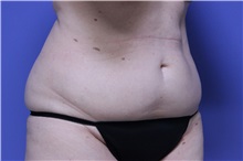Liposuction Before Photo by Jeffrey Scott, MD; Sarasota, FL - Case 35091