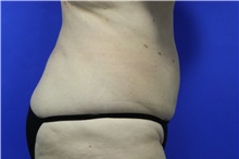 Liposuction After Photo by Jeffrey Scott, MD; Sarasota, FL - Case 35091