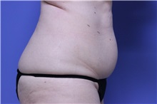 Liposuction Before Photo by Jeffrey Scott, MD; Sarasota, FL - Case 35091