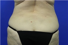 Liposuction After Photo by Jeffrey Scott, MD; Sarasota, FL - Case 35091