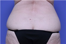 Liposuction Before Photo by Jeffrey Scott, MD; Sarasota, FL - Case 35091