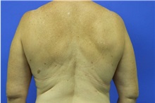 Liposuction After Photo by Jeffrey Scott, MD; Sarasota, FL - Case 35091