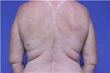 Liposuction Before Photo by Jeffrey Scott, MD; Sarasota, FL - Case 35091