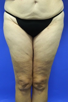 Liposuction After Photo by Jeffrey Scott, MD; Sarasota, FL - Case 35091