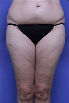 Liposuction Before Photo by Jeffrey Scott, MD; Sarasota, FL - Case 35091