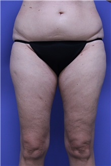 Liposuction Before Photo by Jeffrey Scott, MD; Sarasota, FL - Case 35091