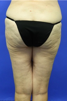 Liposuction After Photo by Jeffrey Scott, MD; Sarasota, FL - Case 35091