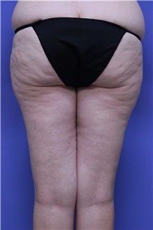 Liposuction Before Photo by Jeffrey Scott, MD; Sarasota, FL - Case 35091