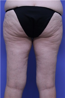 Liposuction Before Photo by Jeffrey Scott, MD; Sarasota, FL - Case 35091