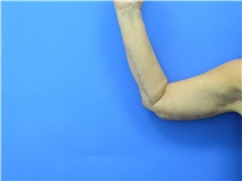 Arm Lift After Photo by Jeffrey Scott, MD; Sarasota, FL - Case 35166