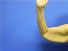 Arm Lift Before Photo by Jeffrey Scott, MD; Sarasota, FL - Case 35166