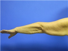 Arm Lift Before Photo by Jeffrey Scott, MD; Sarasota, FL - Case 35166