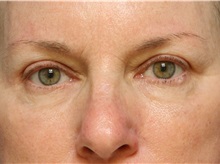 Eyelid Surgery After Photo by Jeffrey Scott, MD; Sarasota, FL - Case 35169