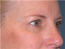 Eyelid Surgery Before Photo by Jeffrey Scott, MD; Sarasota, FL - Case 35169