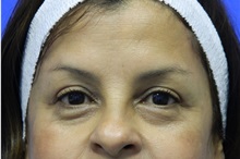 Eyelid Surgery After Photo by Jeffrey Scott, MD; Sarasota, FL - Case 35172