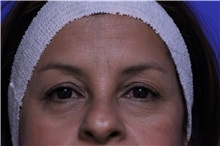 Eyelid Surgery Before Photo by Jeffrey Scott, MD; Sarasota, FL - Case 35172