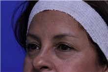 Eyelid Surgery Before Photo by Jeffrey Scott, MD; Sarasota, FL - Case 35172