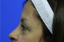 Eyelid Surgery After Photo by Jeffrey Scott, MD; Sarasota, FL - Case 35172